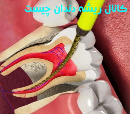 کانال ریشه دندان چیست؟